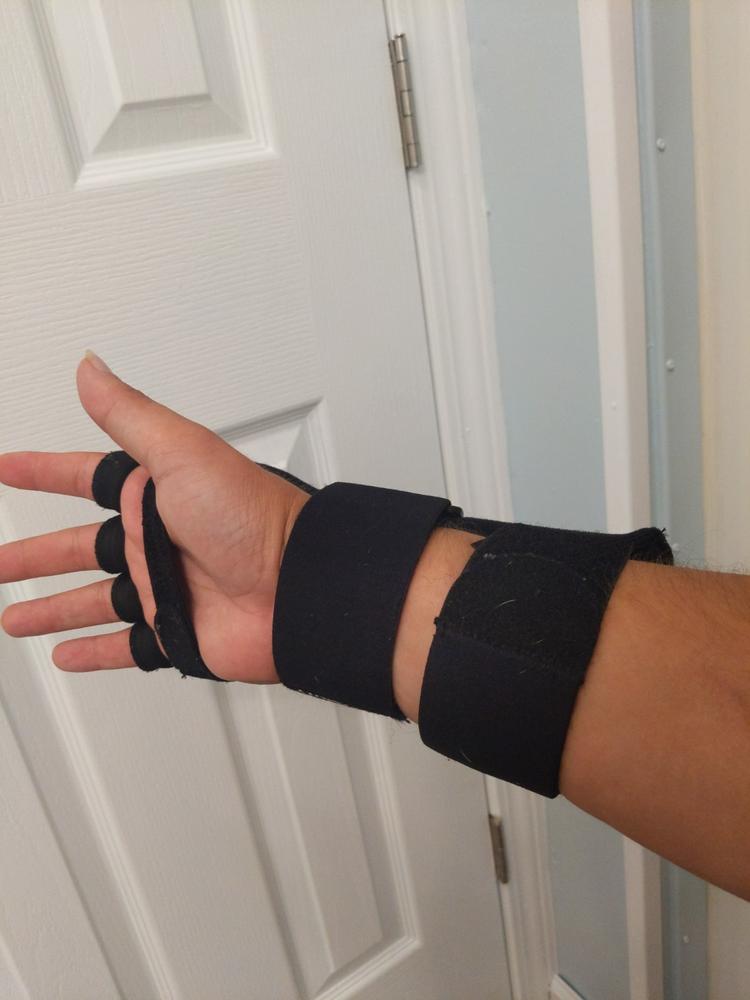 Radial Nerve Palsy Splint | Dynamic Wrist Drop & Finger Extension Brace for Saturday Night, Honeymoon & Crutch Palsy - Customer Photo From Jeff Hunter
