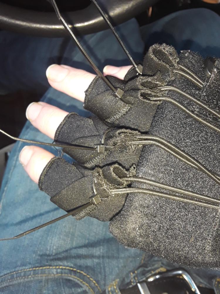 Radial Nerve Palsy Splint | Dynamic Wrist Drop & Finger Extension Brace for Saturday Night, Honeymoon & Crutch Palsy - Customer Photo From James Bayly