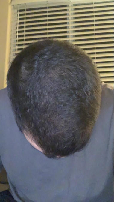 Gray Escape™ Advanced Anti-Gray Hair Growth Supplement - Customer Photo From Anonymous