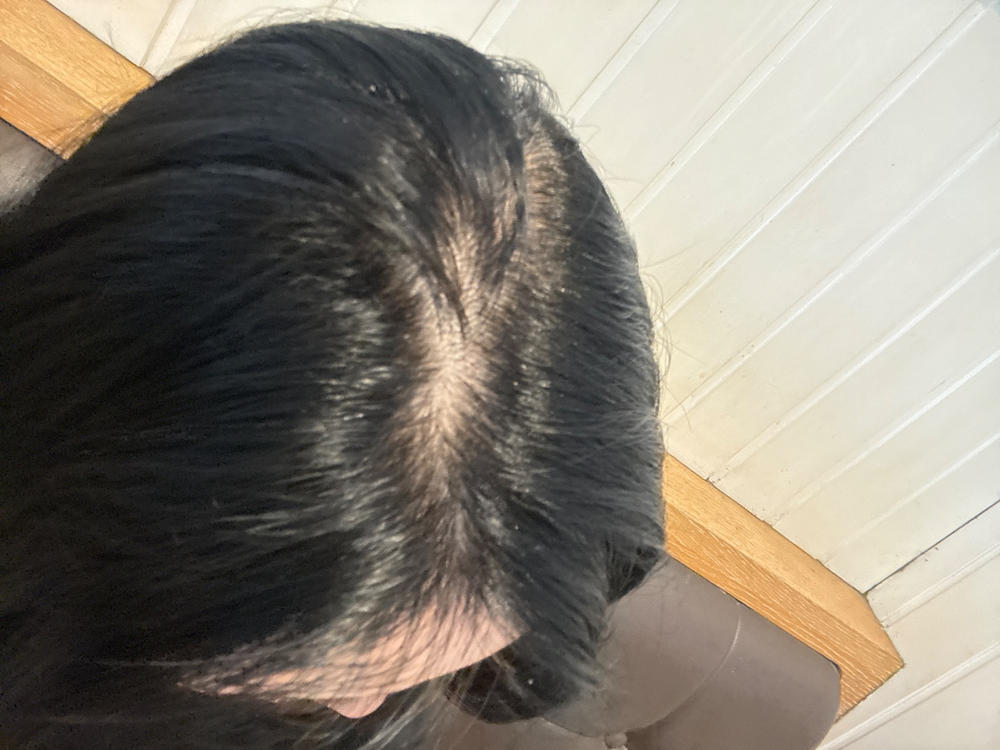 Gray Escape™ Advanced Anti-Gray Hair Growth Supplement - Customer Photo From Anonymous