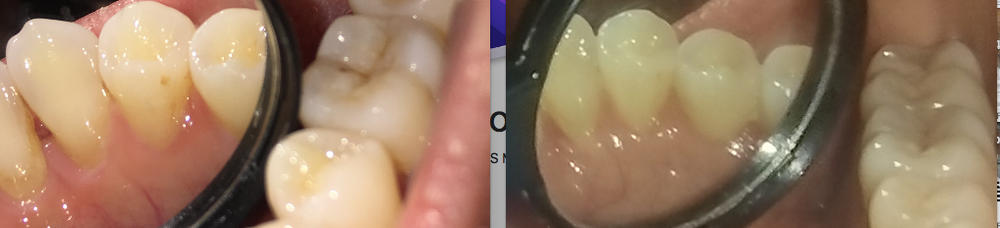 Shine—Remineralizing Tooth Whitening Powder with Hydroxyapatite - Customer Photo From Elizabeth Michelson