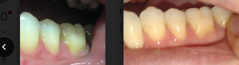 Shine—Remineralizing Tooth Whitening Powder with Hydroxyapatite - Customer Photo From Elizabeth Michelson