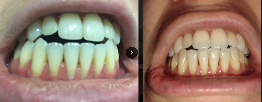 Shine—Remineralizing Tooth Whitening Powder with Hydroxyapatite - Customer Photo From Elizabeth Michelson