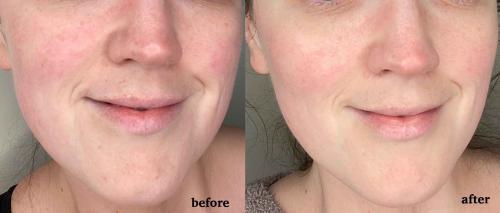 Lanveza LED Beauty Mask - Customer Photo From Tee Tee Marie