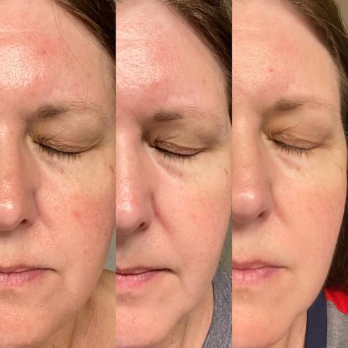 Lanveza LED Beauty Mask - Customer Photo From Anjali Ganess