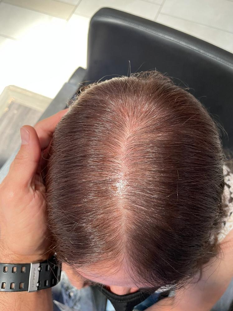 Hairatin Hair Fibers 28 G - Customer Photo From Lynn