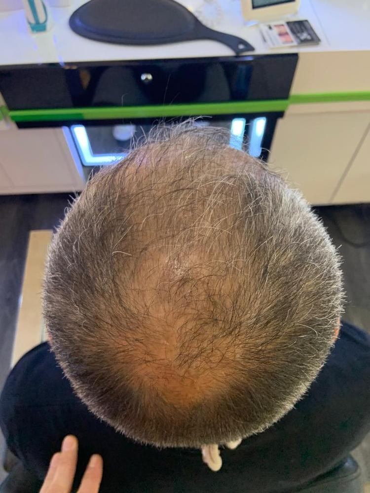 Hairatin Hair Fibers 28 G - Customer Photo From David Slater 
