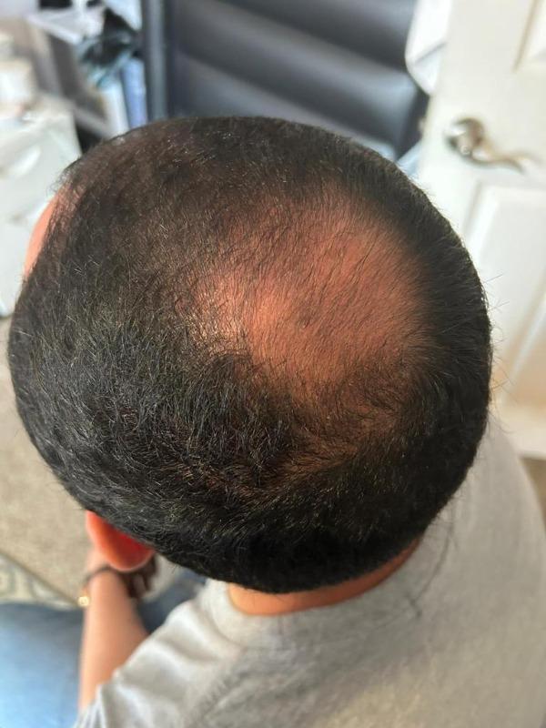 Hairatin Hair Fibers 28 G - Customer Photo From Andrés