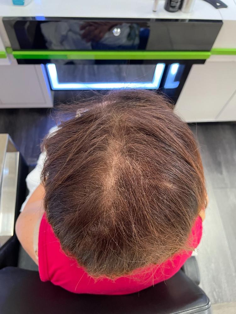Hairatin Hair Fibers 28 G - Customer Photo From Beverly Craig !!