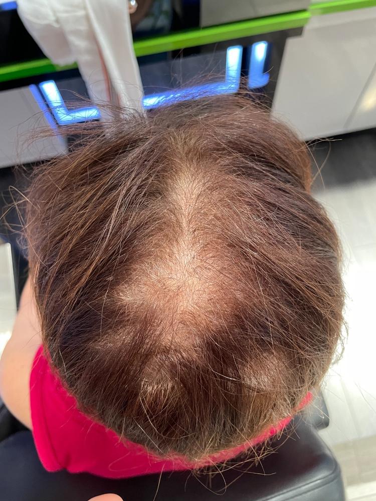 Hairatin Hair Fibers 28 G - Customer Photo From Beverly Craig !!
