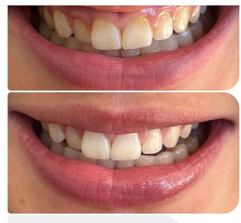 Before & After - 7 Days