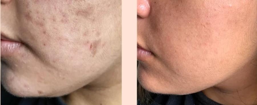 Ultra Glow Serum Kit - Customer Photo From Neesha
