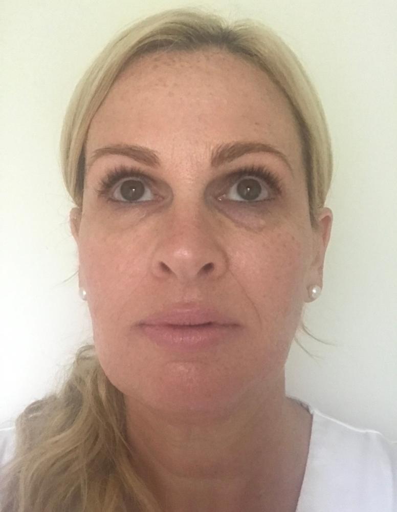 LED + RF Wrinkle Eraser Pen + Free Derma Fill - Customer Photo From Paula Kelly