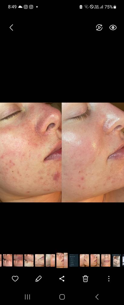 Salicylic Acid Serum - Customer Photo From Kate 