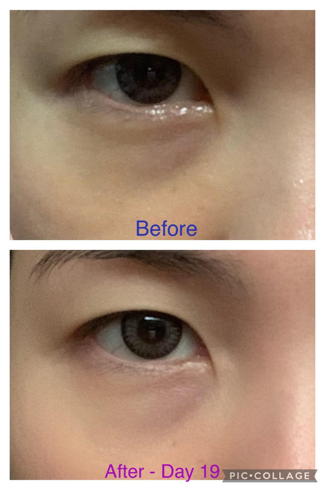 [PROMO] Jung Beauty Firming Microdart Eye Patch with Bakuchiol, Niacinamide and Peptides - Customer Photo From Sylvia Yeo