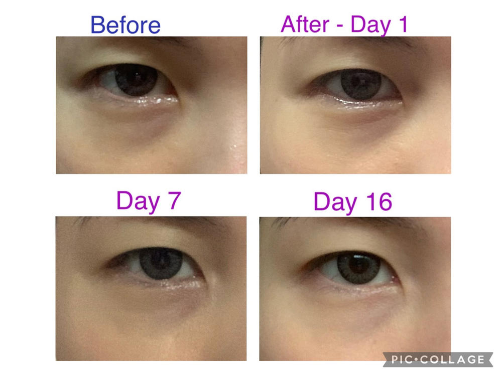 [PROMO] Jung Beauty Firming Microdart Eye Patch with Bakuchiol, Niacinamide and Peptides - Customer Photo From Sylvia Yeo