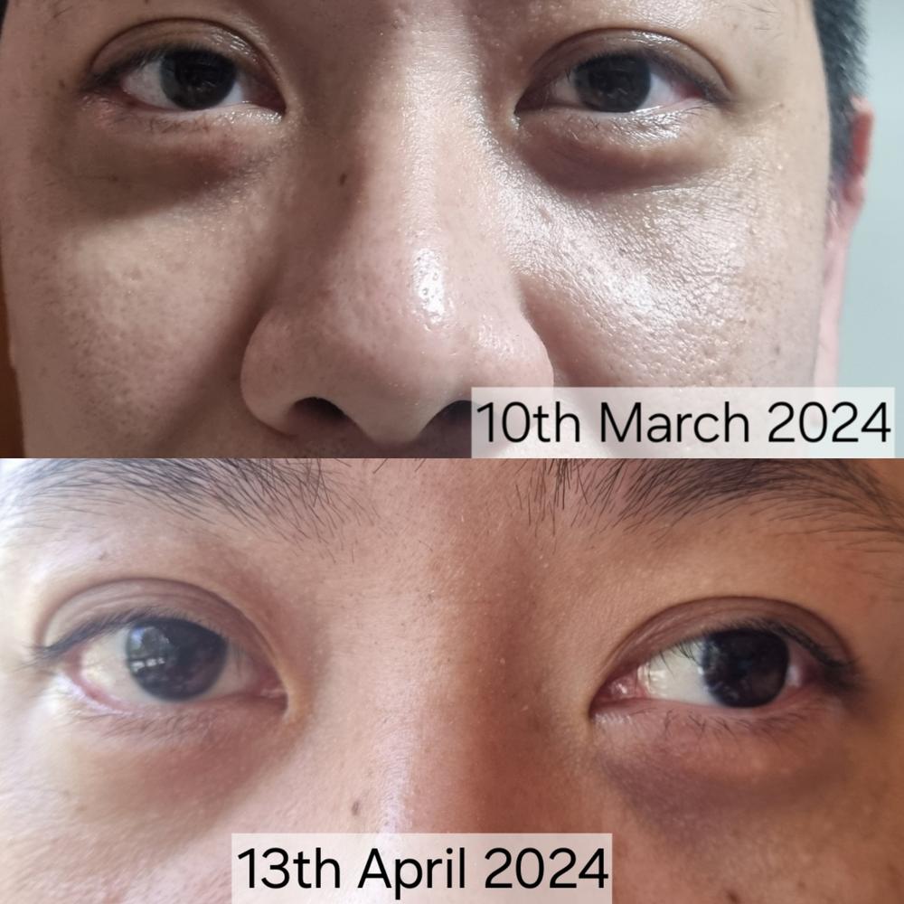 Jung Beauty Firming Microdart Eye Patch with Bakuchiol, Niacinamide and Peptides - Customer Photo From Fion