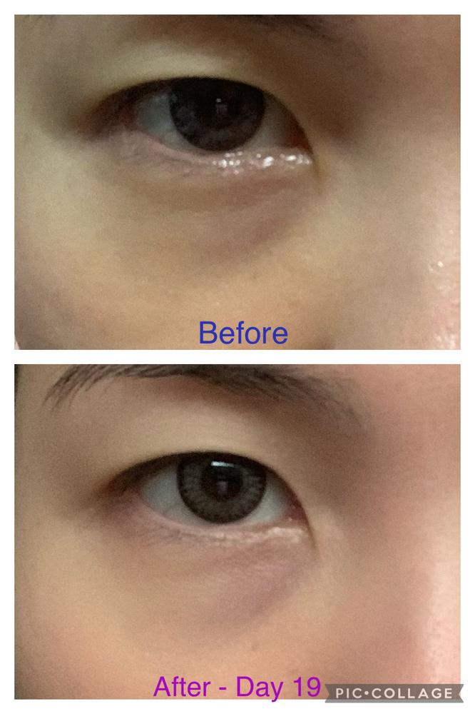 Jung Beauty Firming Microdart Eye Patch with Bakuchiol, Niacinamide and Peptides - Customer Photo From Happy