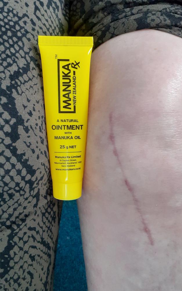Skin Rescue Ointment - Customer Photo From Cheryl Pearson