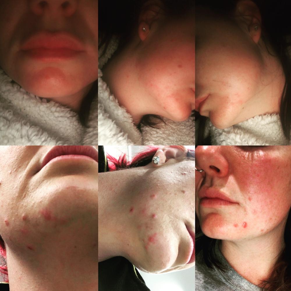 Ultimate Blemish Control Routine - Customer Photo From Carly 