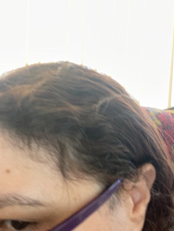 Anti-Hair Loss Concentrated Treatment - Customer Photo From Anonymous