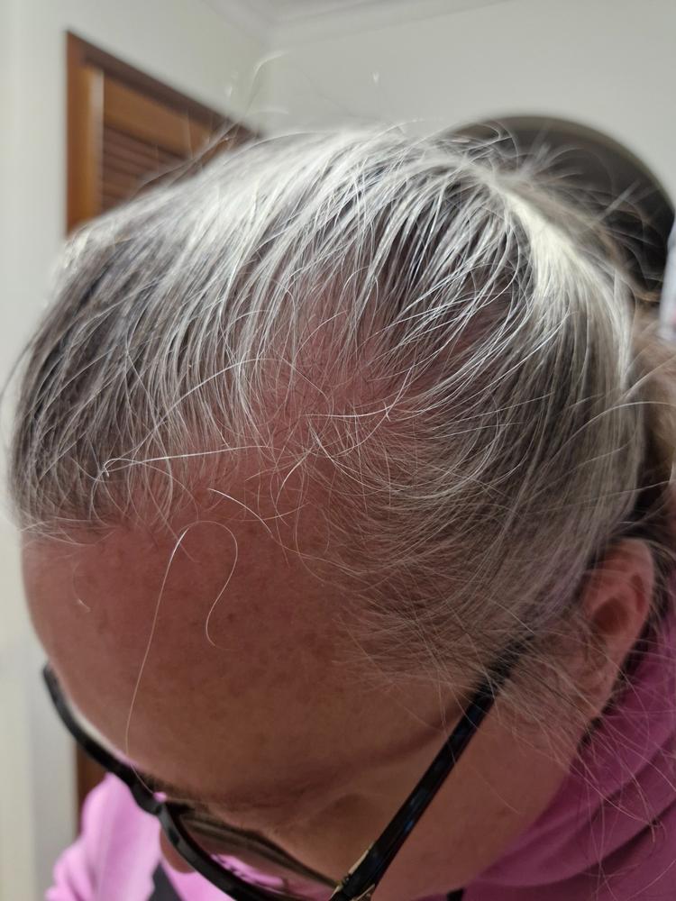 Anti-Hair Loss Treatment Pack - Customer Photo From Gillian Williams