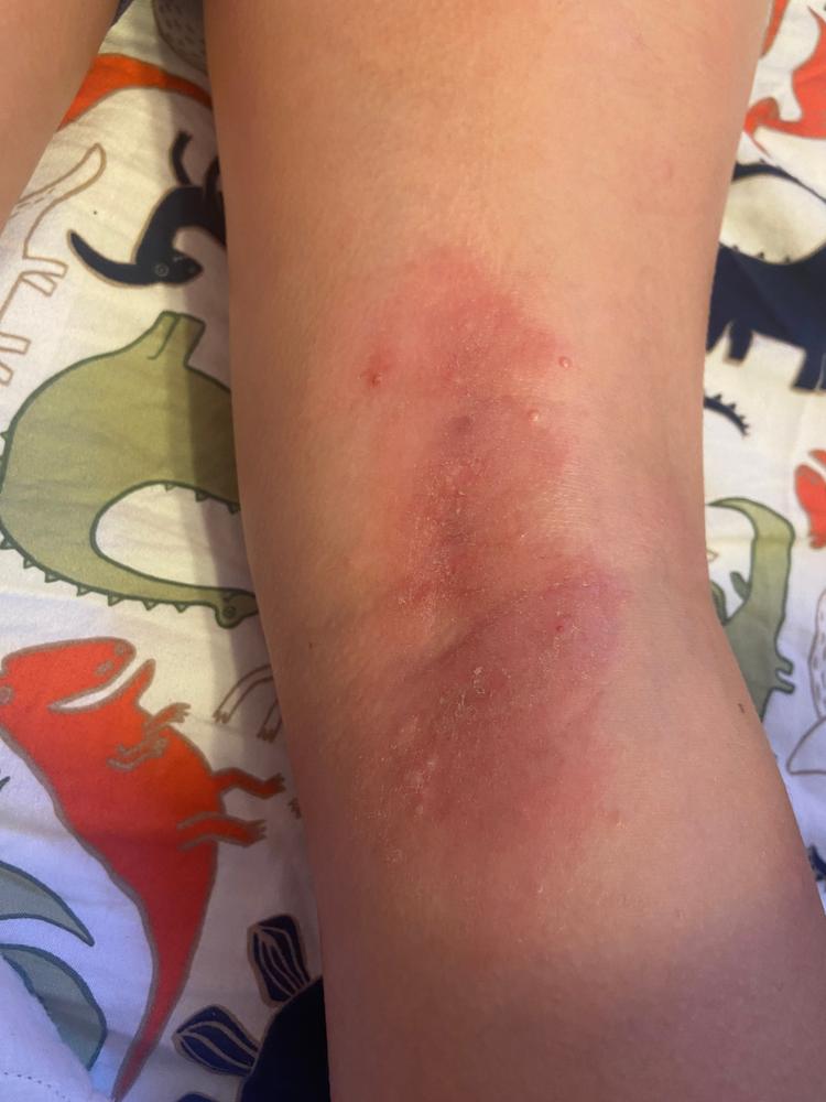 Remedywear™ (TENCEL + Zinc) Sleeves/Bandages for Babies to Adults (One Pair) - Customer Photo From Emily