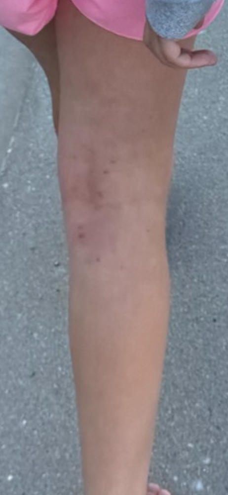Remedywear™ (TENCEL + Zinc) Sleeves/Bandages for Babies to Adults (One Pair) - Customer Photo From Emily
