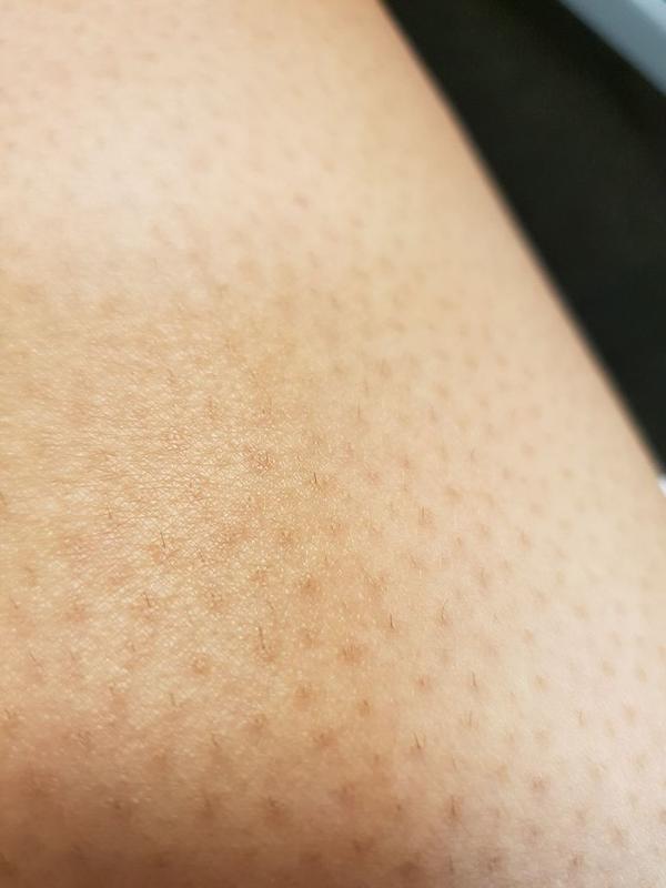1 Million Flash Digital Laser Hair Removal - Customer Photo From Michelle G