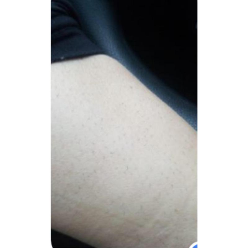1 Million Flash Digital Laser Hair Removal - Customer Photo From Sabrina F