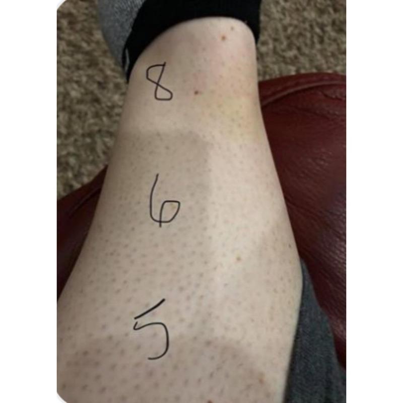 1 Million Flash Digital Laser Hair Removal - Customer Photo From Margaret H