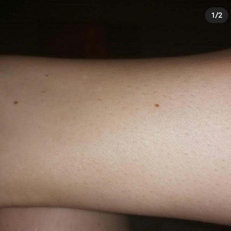1 Million Flash Digital Laser Hair Removal - Customer Photo From Debra P