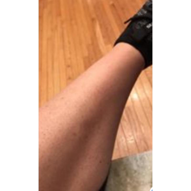 1 Million Flash Digital Laser Hair Removal - Customer Photo From Kimberly K