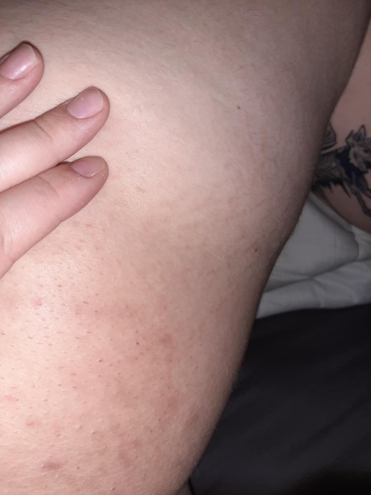 Nude Ingrown Hair Oil - Customer Photo From Anonymous