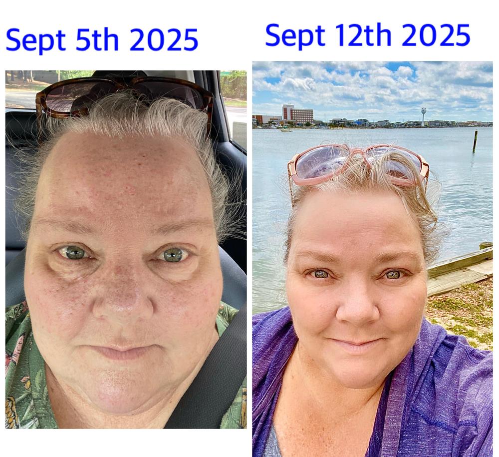 Yauvari Amplified Youth Spring - Best Face Moisturizer for Dry Skin, Aging or Mature Skin - Replaces Your Anti Aging Moisturizer - Natural Skincare with Natural Vitamin E, Vitamin A, Vitamin B - Customer Photo From Carolyn