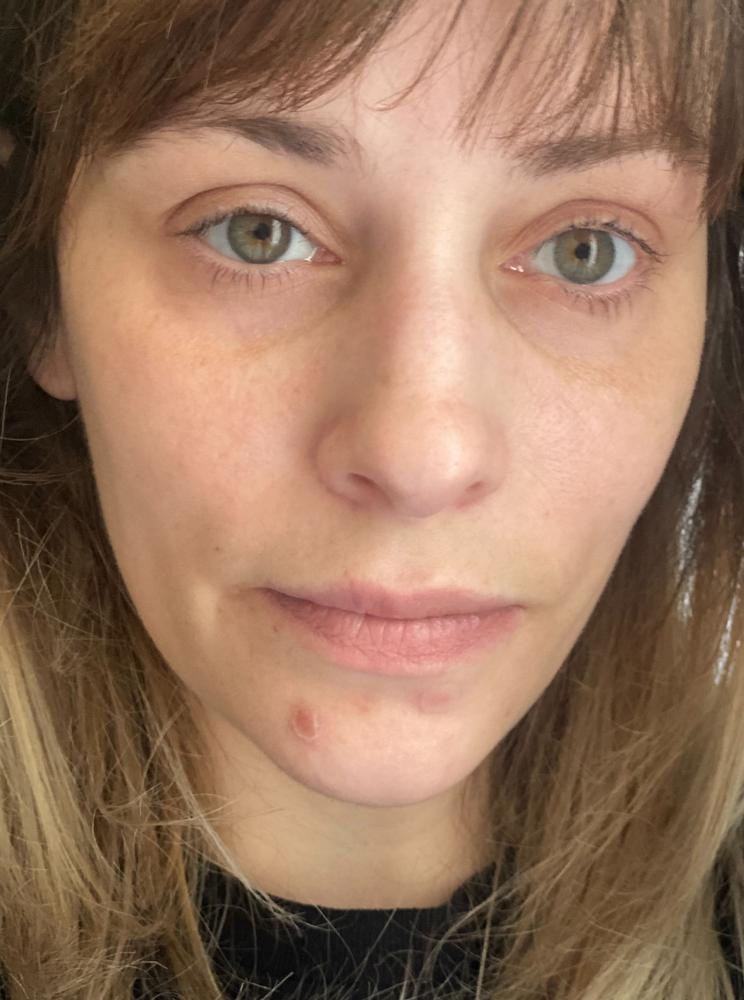Cápsulas Clearizy para una piel limpia y alivio de brotes - Control del acné 5 en 1 | Etiqueta limpia 100 % natural | Acción rápida y duradera - Customer Photo From Jessica E.