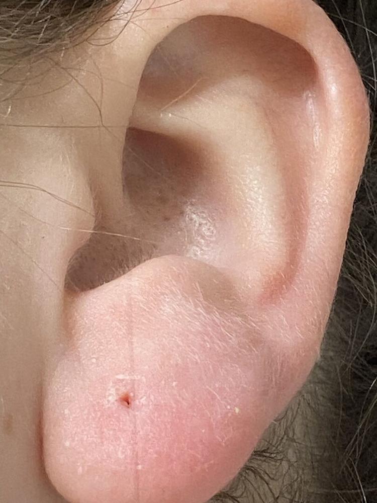 Medical Plastic 5mm Daisy Earrings - Customer Photo From Emilee G.