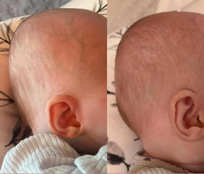 Perfect Noggin Head Shaping Mattress - Customer Photo From Mikayla