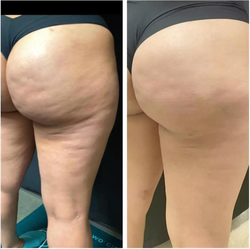 Cheek Chic Cellulite Gel - Customer Photo From Veronica