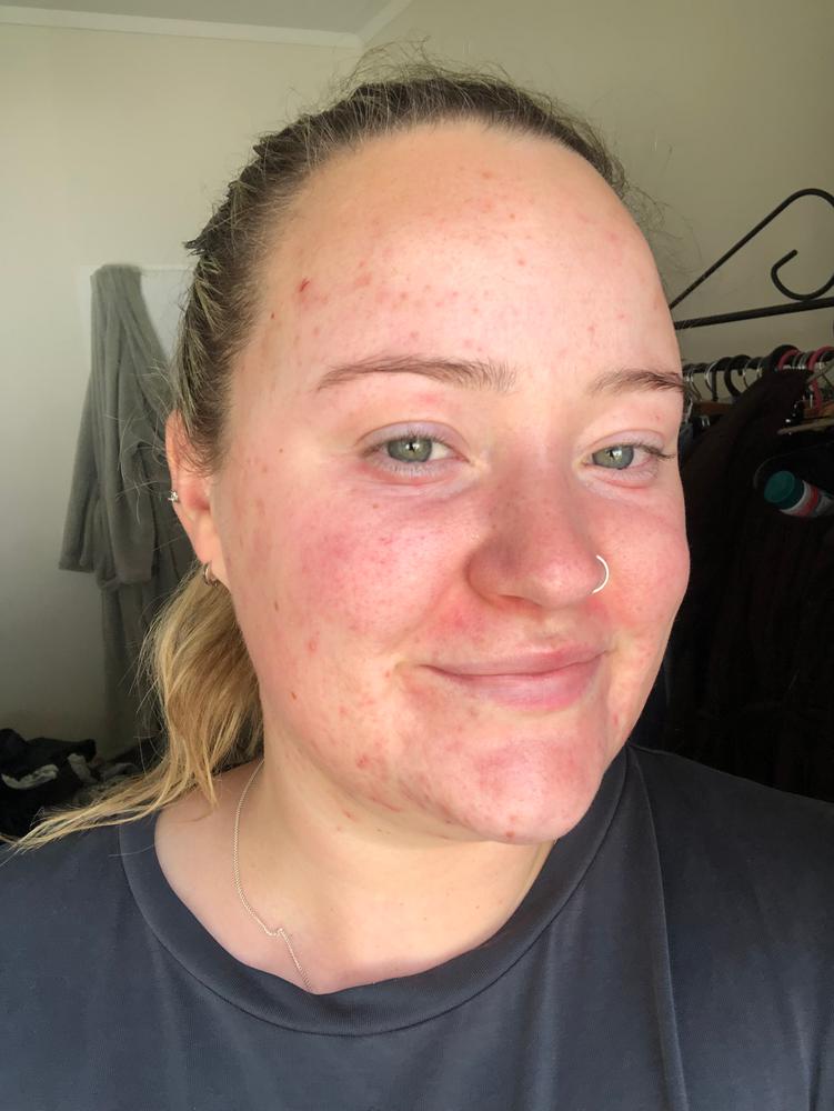 Precision Cleanse Pro (White) - Customer Photo From Emma