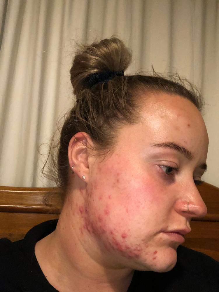 Precision Cleanse Pro (White) - Customer Photo From Emma