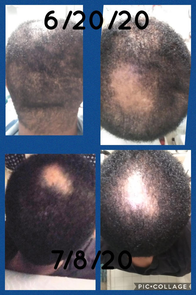 Organic Hair Growth Oil - Customer Photo From Anonymous