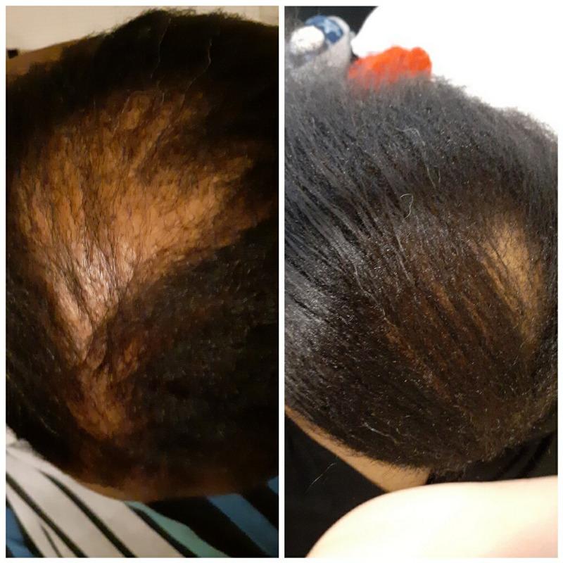 the Balm! - Hair Growth Treatment - Customer Photo From Reva Grant