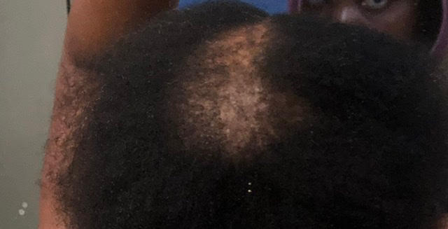 the Balm! - Hair Growth Treatment - Customer Photo From Gwenda Alexander