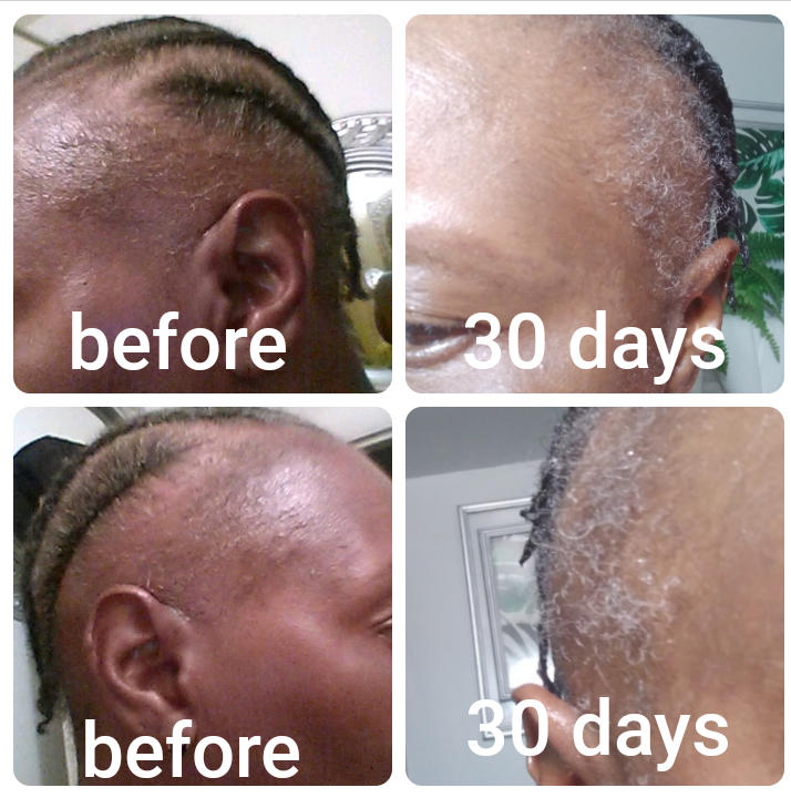 the Balm! - Hair Growth Treatment - Customer Photo From Monica Witter