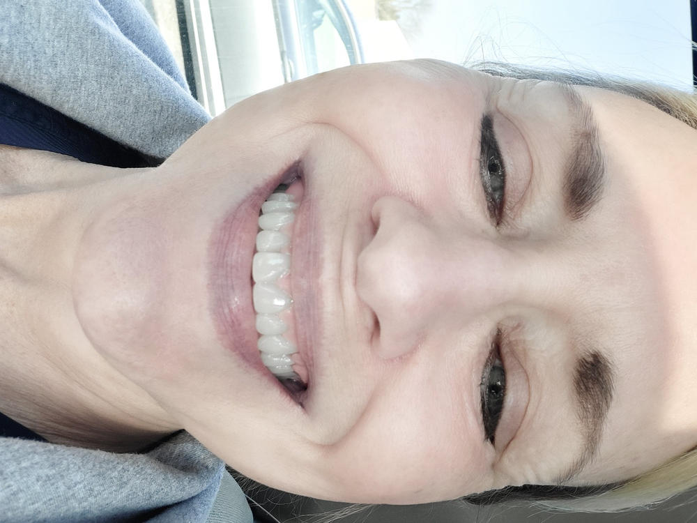 Patient Self Fitting - Functional Dentures - DIY - Flex Fit - Less Than 5 Minutes - Easy Denture™ - Upper & Lower Dentures - Customer Photo From Lisa McNeal