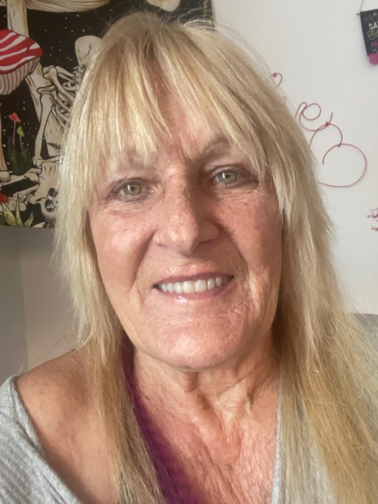 Patient Self Fitting - Functional Dentures - DIY - Flex Fit - Less Than 5 Minutes - Easy Denture™ - Upper & Lower Dentures - Customer Photo From Teresa Robles