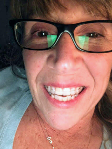 The Retainer - for teeth retention and teeth grinding - Customer Photo From Susan Gottschalk