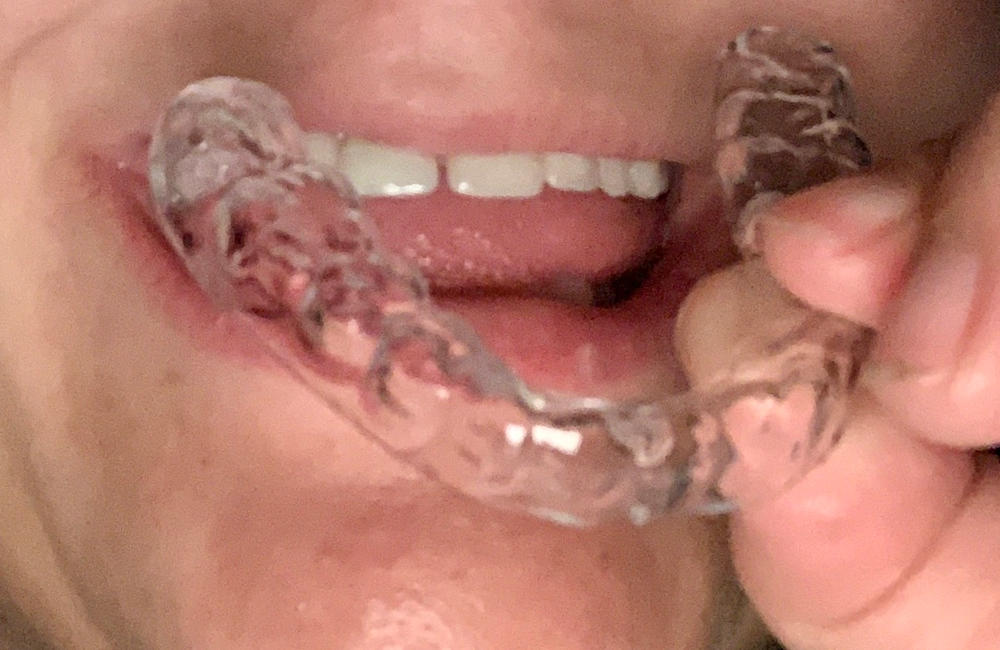 The Retainer - for teeth retention and teeth grinding - Customer Photo From KAYLA SOLIS