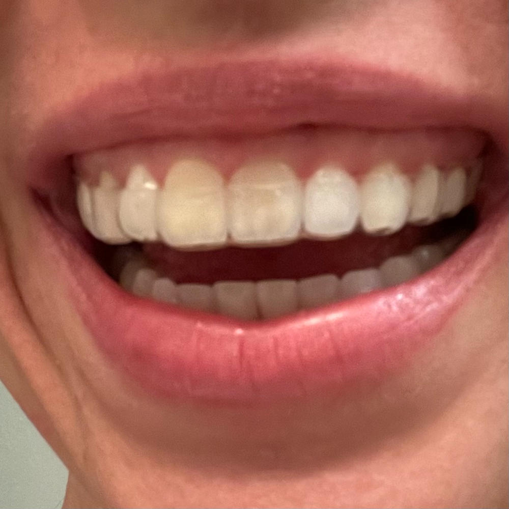 The Retainer - for teeth retention and teeth grinding - Customer Photo From Jana Burkholder